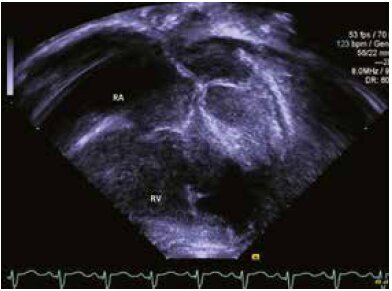 Электрокардиограмма, показывающая синусовую тахикардию, правую диаграмму (ось сердца> 180o) и гипертрофию правого желудочка